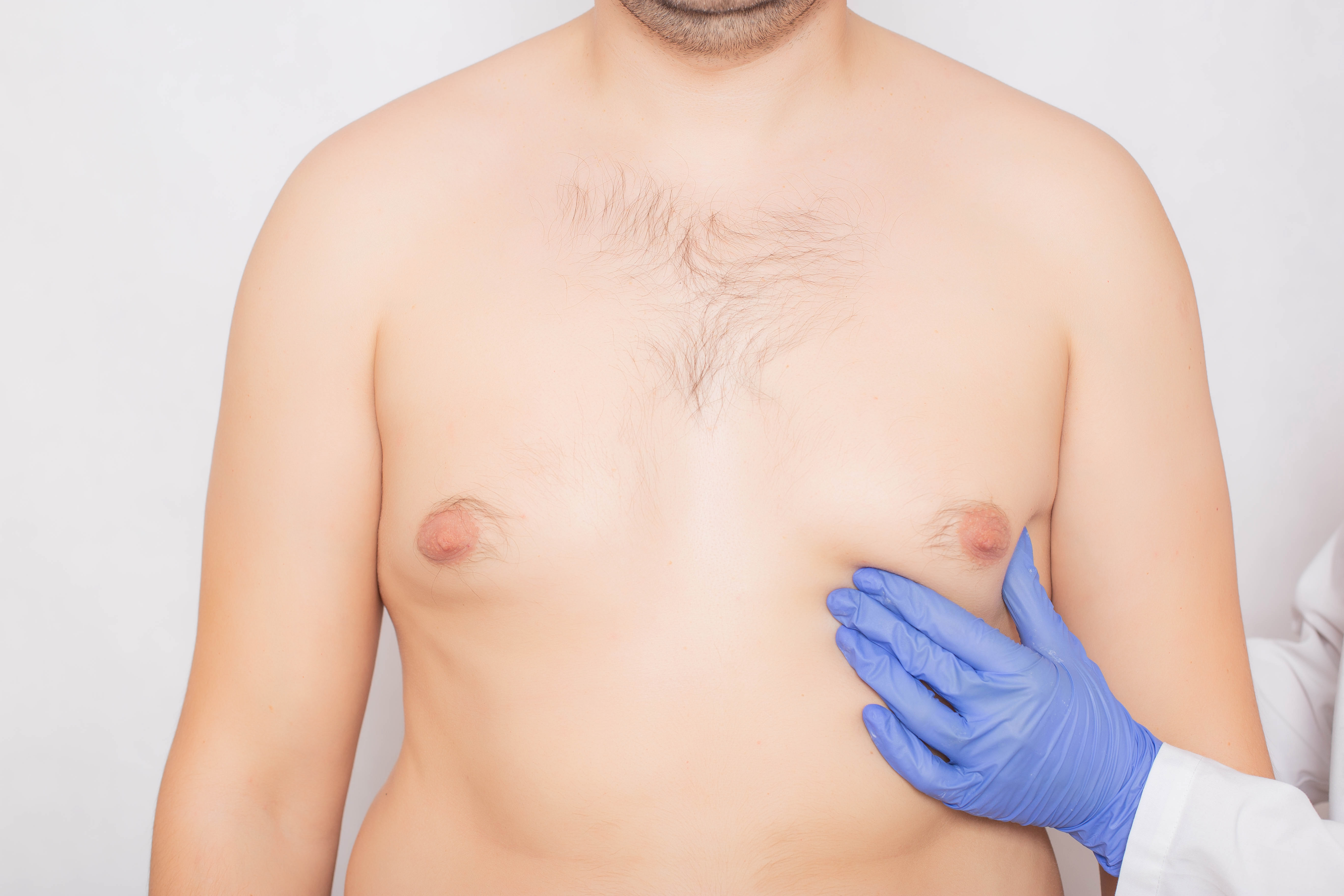 Puffy Nipples Men: What are Puffy Nipples? Causes and Treatments