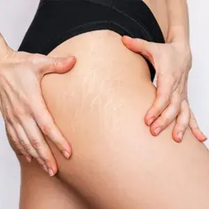 Stretch marks on thighs: Appearance, causes, and treatments